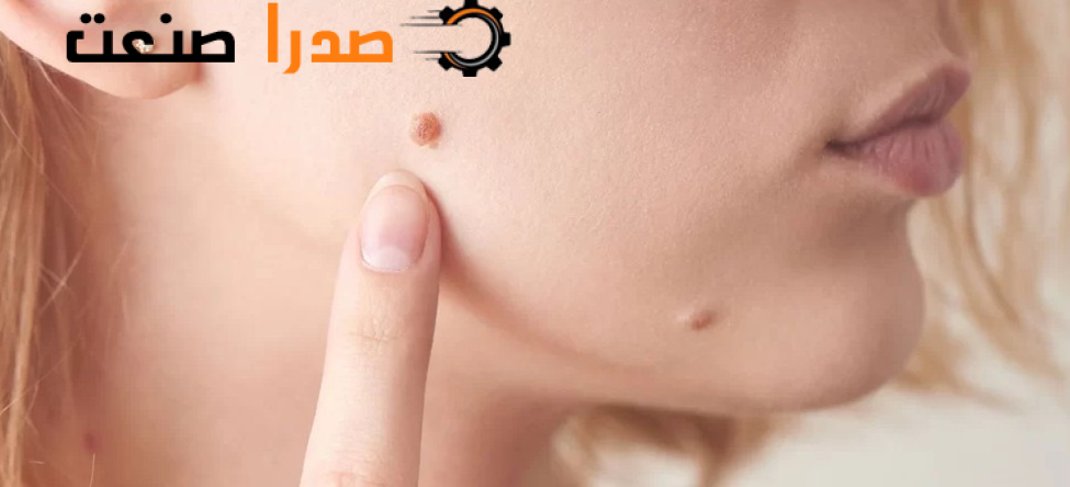 چرا بعد از فریز زگیل تناسلی دچار خارش می‌شویم؟